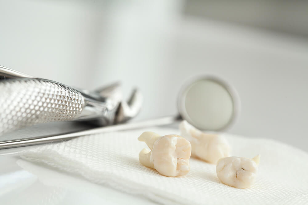Extractions de dents de sagesses