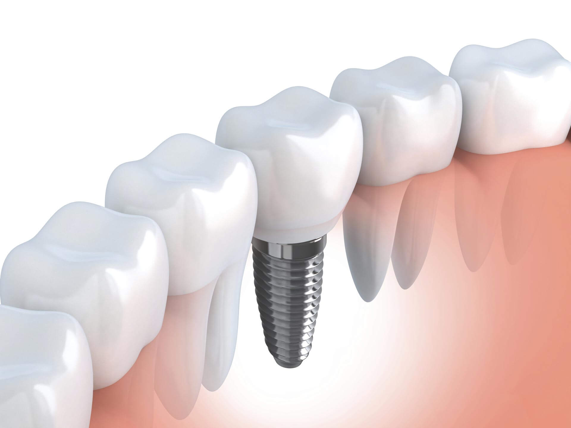 Implants dental