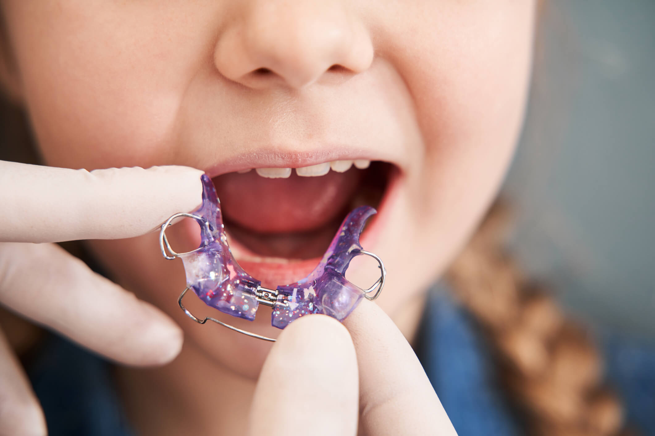 Les traitements orthodontiques adulte clinique Cossette & Ruel