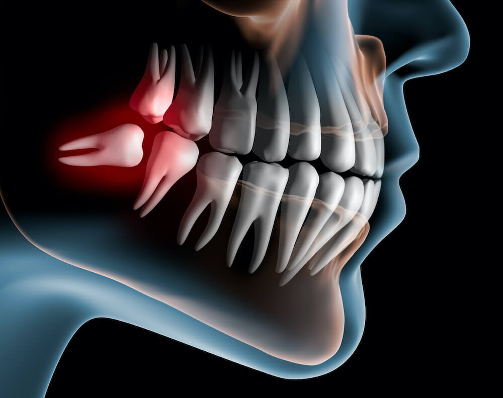 Post-operative care